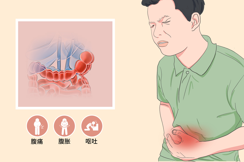 贊！不用開(kāi)刀，一根導(dǎo)管打通腸梗阻！